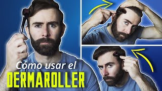 Cómo Usar El Dermaroller Para Recuperar El Pelo [upl. by Cassondra834]