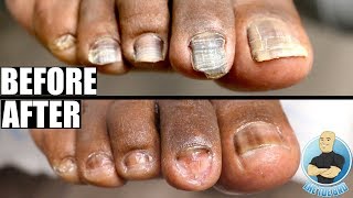 TOENAIL GLOW UP TRANSFORMATION FROM BAD TO BEAUTIFUL TOENAILS [upl. by Dahs]