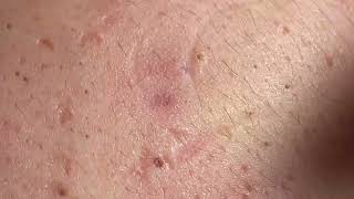 Acne Treatment Huong Da Nang  2024 blackheads 703 [upl. by Layor]