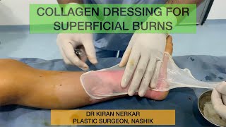 Collagen Dressing in first degree burns  Dr Kiran Nerkar  Plastic Surgeon Nashik [upl. by Idleman879]