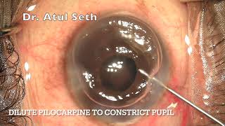 PHACO in rigid non dilating pupil with BHex Ring  DR ATUL SETH [upl. by Ainex]