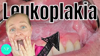 Leukoplakia  Causes Diagnosis amp Treatment WHAT CAUSES LEUKOPLAKIA [upl. by Anida]