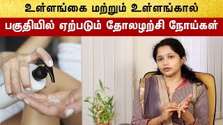 How To Treat Hand And Leg Eczema problems  எக்ஸிமா தோலழற்சி நோய் ஏற்பட காரணம் [upl. by Fablan]