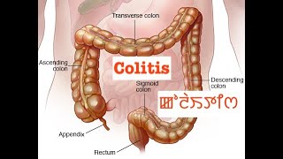 Colitis ꯀꯣꯂꯥꯏꯇꯤꯁ [upl. by Ryder755]