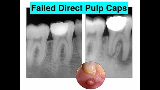 Direct Pulp Capping This is What You Don’t Want To Do 🤭  Dr Ricucci [upl. by Ehud73]