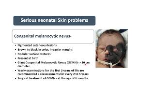 Congenital Melanocytic Nevus  Spot Diagnosis 27  Pediatrics [upl. by Bev]