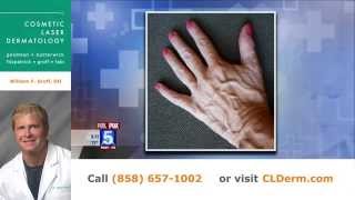 Dr Groff Answers Skincare Questions about the Hands [upl. by Latsyrhc]