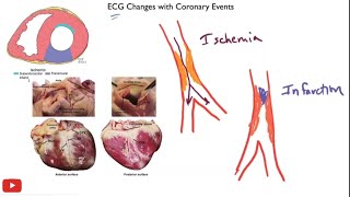 Myocardial ischemia amp infarction  STEMI NSTEMI Q wave infarction Wellens syndrome [upl. by Shannah747]