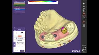 Exocad custom abutment 3rd video copy teeth [upl. by Weissberg248]