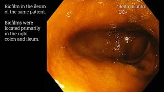 Examples of endoscopically visible gastrointestinal biofilms [upl. by Adranoel]