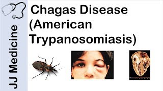 Chagas Disease  American Trypanosomiasis  Causes Symptoms and Treatment [upl. by Nylatsirhc]