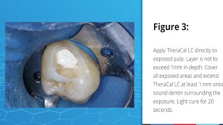 Direct Pulp Capping Case using TheraCal LC [upl. by Packer494]