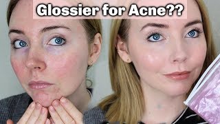 Glossier for Acne Prone Skin  Does it Work My Tips [upl. by Lanahtan761]