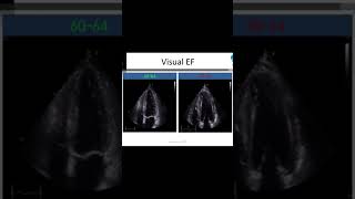 EF 29 or less severe EF visual EF eyeball estimation ejection fraction echocardiography [upl. by Darda516]