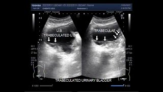 A Trabeculated urinary bladder patient aged 60 years [upl. by Enelrahc114]