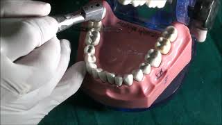 CLASS II Cavity preparation Base Application for Restoration of Silver Amalgam [upl. by Eno]