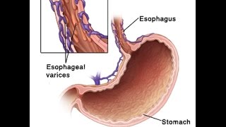 Esophageal Varices [upl. by Brok]