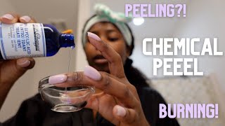 At Home Chemical Peel on Black Skin  Esthetician Approved [upl. by Anzovin]