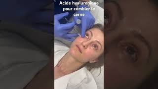 L’acide hyaluronique pour effacer les cernes creux  Dr Raspaldo cernes medecineesthetique [upl. by Nnitsuj]