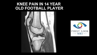 Knee pain in 14 year old football player [upl. by Eirol]