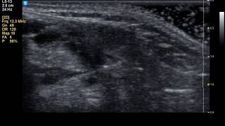 Ultrasound guided hydrodissection of posterior tibial nerve3 [upl. by Joscelin]