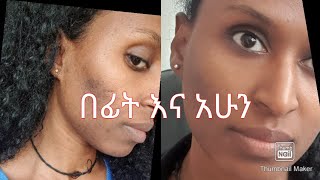 የቡግር የማድያት በአንድ ወር እውነተኛ ማፍዘዣ እና ማጥፊያ ዘዴ ordinary rosehip oil [upl. by Walley]