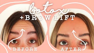 Getting Botox  Brow Lift  Before amp After VLOG [upl. by Marou]