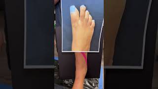 HALLUX VARUS CORRECTION USING MINIMALLY INVASIVE TECHNIQUE🦶🏼shorts halluxvarus [upl. by Riggall]