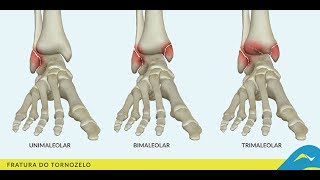 Fratura Trimaleolar do Tornozelo Mulligan  MWM com Cinto Clínica de Fisioterapia Dr Robson Sitta [upl. by Enaasiali]