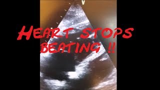 Cardiology Echo QuizCase Heart stops beating Part 1 SCD VT SVT AVRT AVNRT Sinus Tach [upl. by Harad]