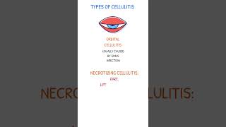 ORBITAL amp NECROTIZING CELLULITIS [upl. by Ainavi]