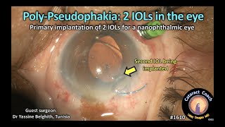 CataractCoach 1610 poly pseudophakia 2 IOLs in the eye [upl. by Ahsyekal]