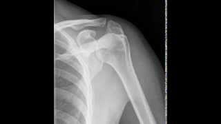 2 View Standard Shoulder Radiographic Tutorial [upl. by Loomis]