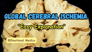 Global cerebral ischemia  Ischemia and infarction  CNS pathology  emotionalmedico [upl. by Sydel]