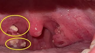 easy way to get rid of tonsil stones in the throat [upl. by Crotty]