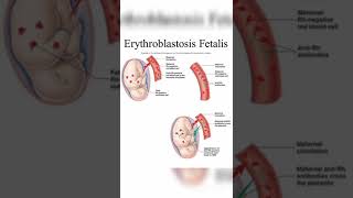 Erythroblastosis fetalisRh incompatibility [upl. by Williamsen]