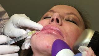 Restylane Refyne Lip Enhancement  Dr Weiner [upl. by Harms]