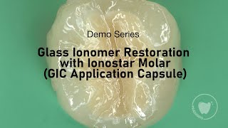 Glass Ionomer Restoration with Ionostar Molar GIC Application Capsule  VOCO GmbH [upl. by Gnot]