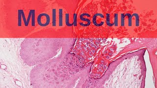 Molluscum Contagiosum  Pathology mini tutorial [upl. by Carce912]