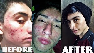 ELIMINA EL ACNE CON ISOTRETINOINA  Me curo el acne 100 [upl. by Pauiie]