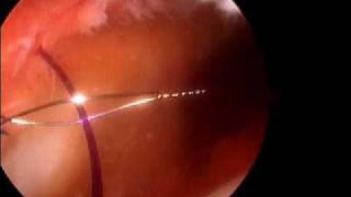 Arthroscopic Medial patella plication Dr A Reznik [upl. by Fernandina2]