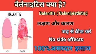 बैलेनाइटिस  Balanitis Best Treatment of Balanitis  cause ✅ Best Homeopathic Doctor in India ✅ [upl. by Legnaros230]