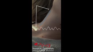 Normal Jugular Venous Pulse Narrated [upl. by Parnell547]