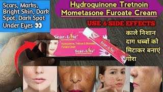 Hydroquinone Tretnoin Mometasone Furoate Cream  Scarlite  use and Side effects [upl. by Airliah]