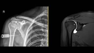 What is an MRI shoulder arthrogram [upl. by Chic859]