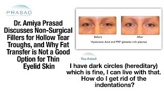 How to Treat Under Eye Indentations amp Dark Circles with Fillers and PlateletRich Plasma [upl. by Alded]