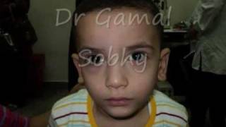 الحول الوحشي المتقطع  Intermittent Exotropia [upl. by Holcman774]