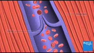 How deep vein thrombosis DVT forms  Bupa Health [upl. by Molli43]