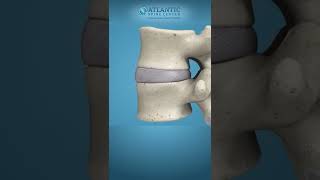 What is Lumbar Disc Herniation Shorts Atlantic Spine Center [upl. by Norrab]