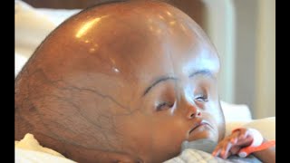 Hydrocephalus treatment and surgical shunt کۆبونەوەی ئاو لەسەردا [upl. by Wicks196]